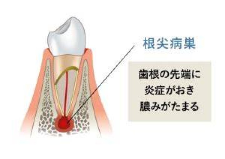 神経を抜いた歯を押すと痛いときのイメージ